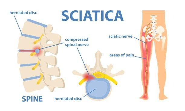 Sciatica Laser Relief Boston MA